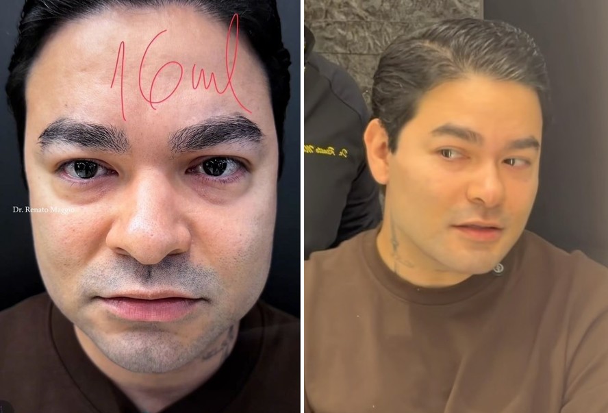 Yudi Tamashiro após procedimento de harmonização facial