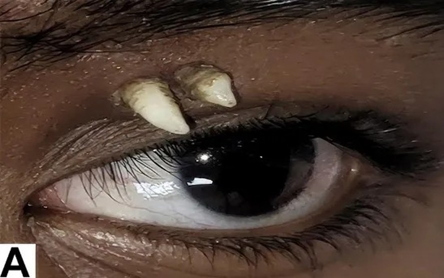 Adolescente com dente ectópico próximo ao olho