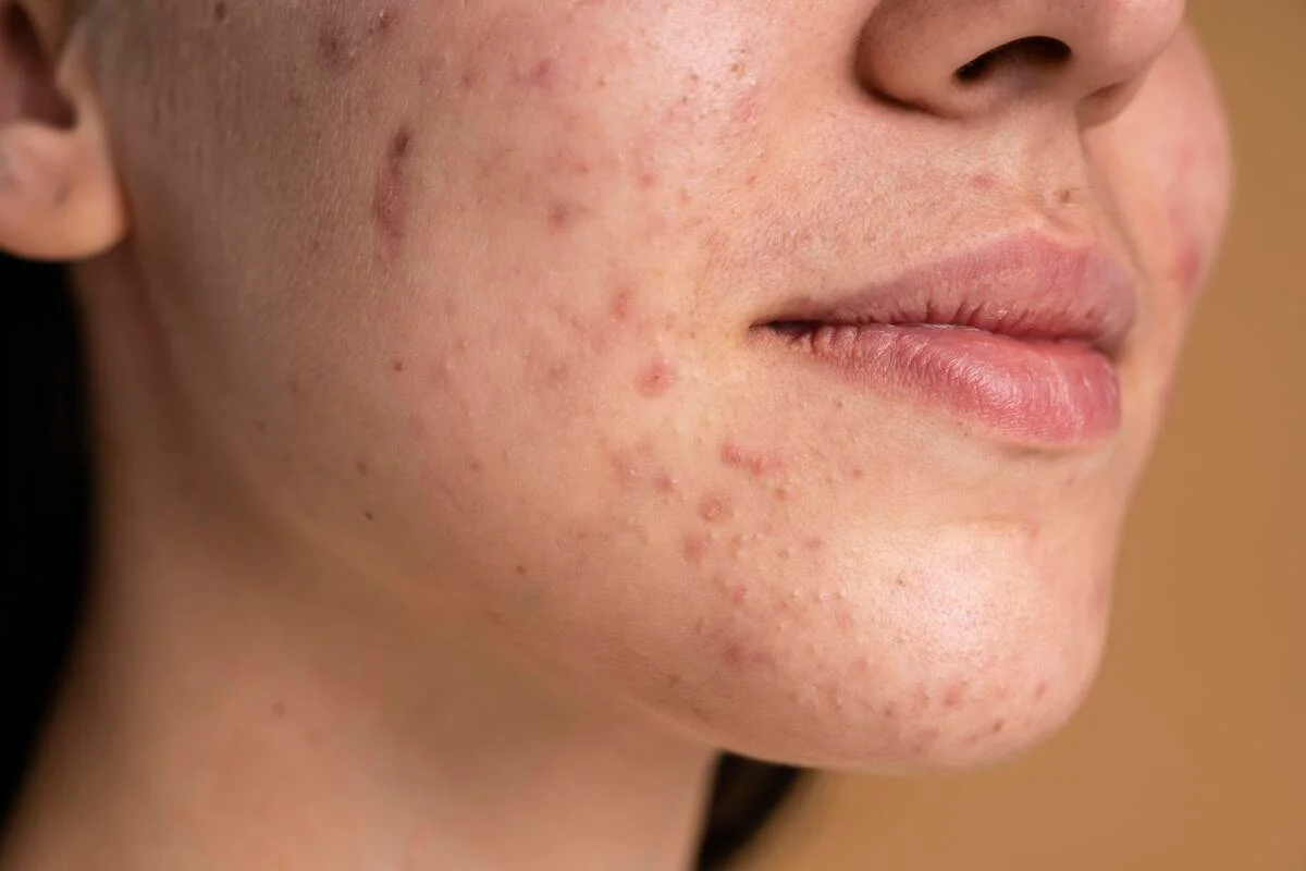 Acne inflamada na pele do rosto