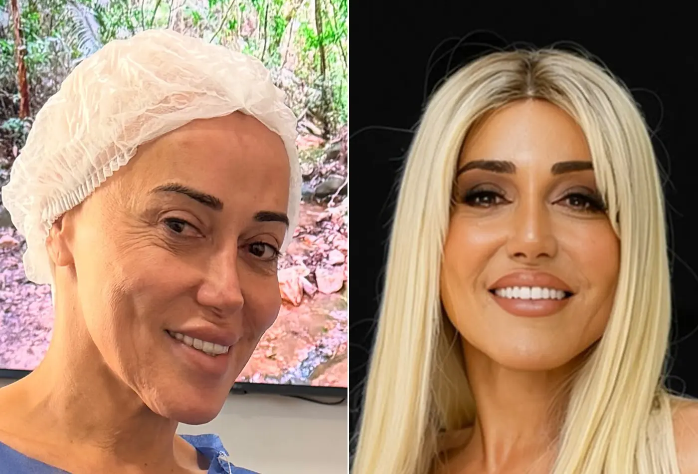 Marcela Porto, a Mulher Abacaxi, antes e depois da feminização facial